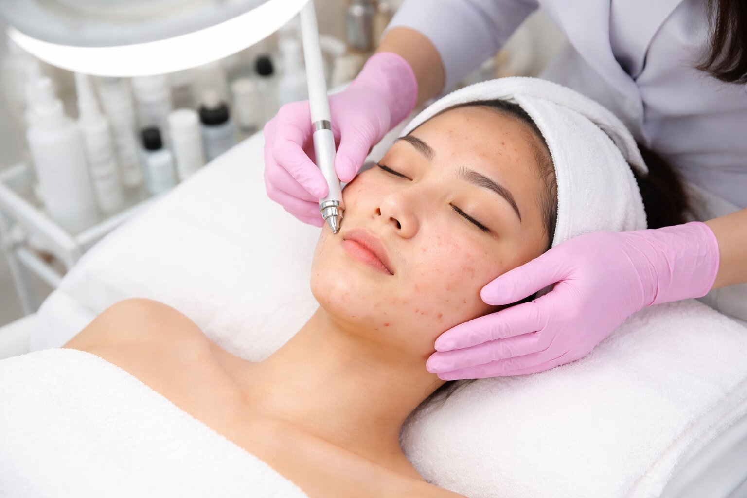 Solusi Jerawat Batu di Klinik Kecantikan, Perawatan Aman & Terbukti Efektif